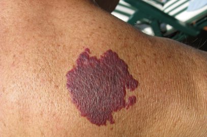 When to Consider Birthmark Removal