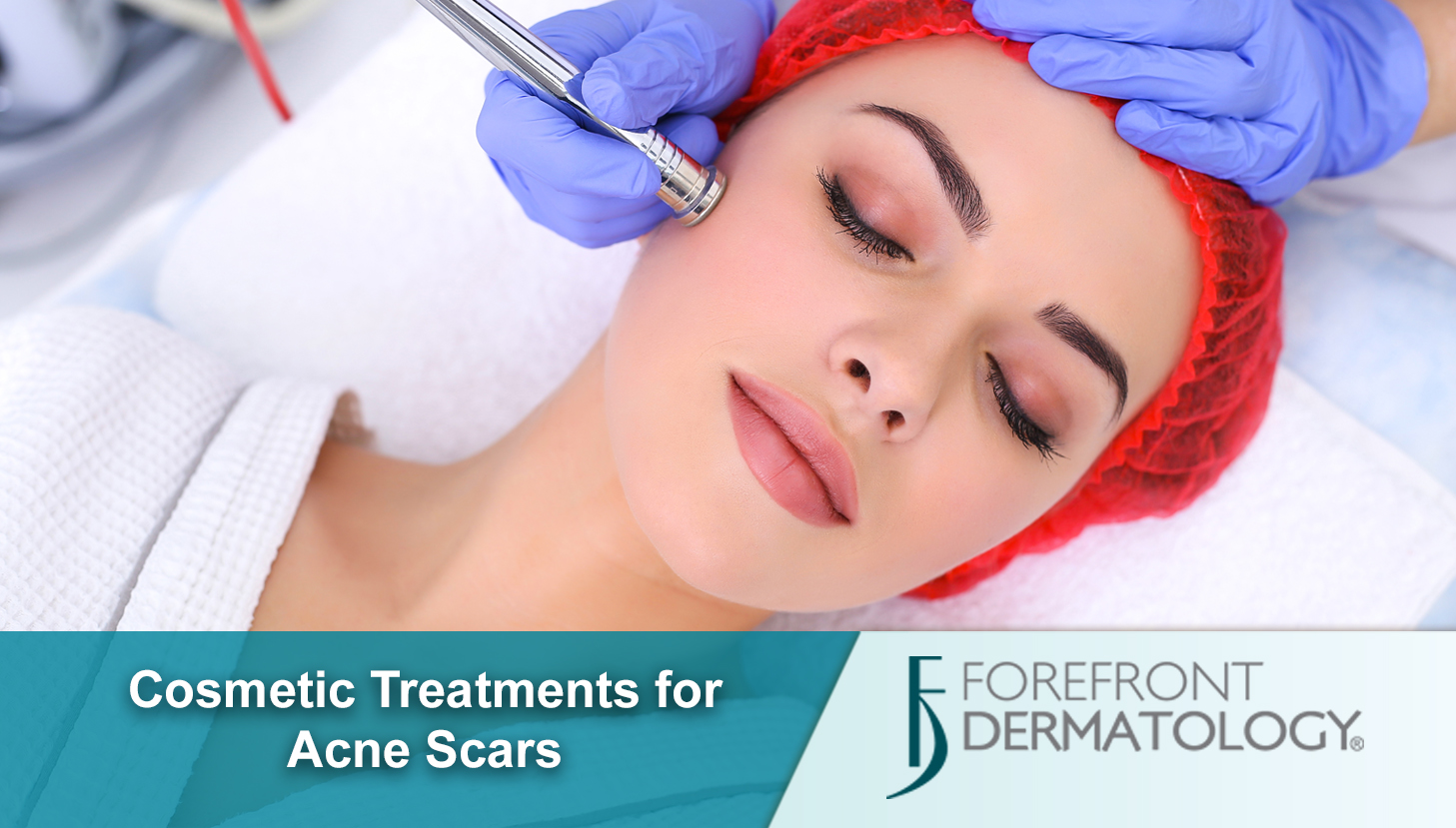 Cosmetic Treatments for Acne Scarring