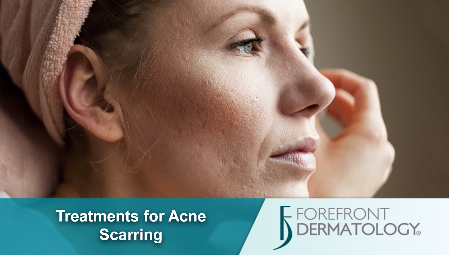 Treatments for Acne Scarring