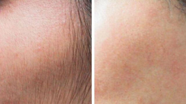 Before and after laser hair removal