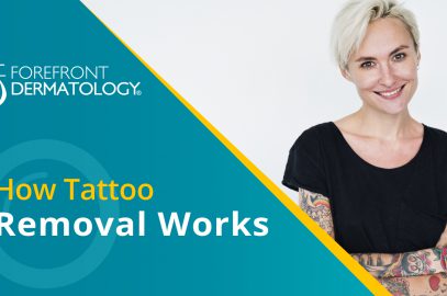 How Tattoo Removal Works