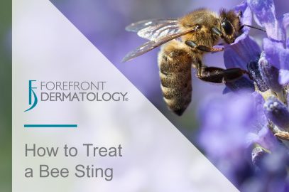 How to Treat a Bee Sting