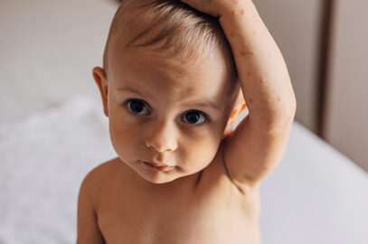 Hand, Foot and Mouth Disease: What You Need to Know