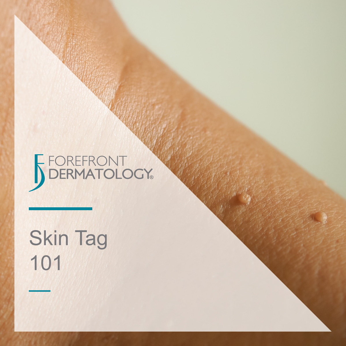 Skin Tag 101