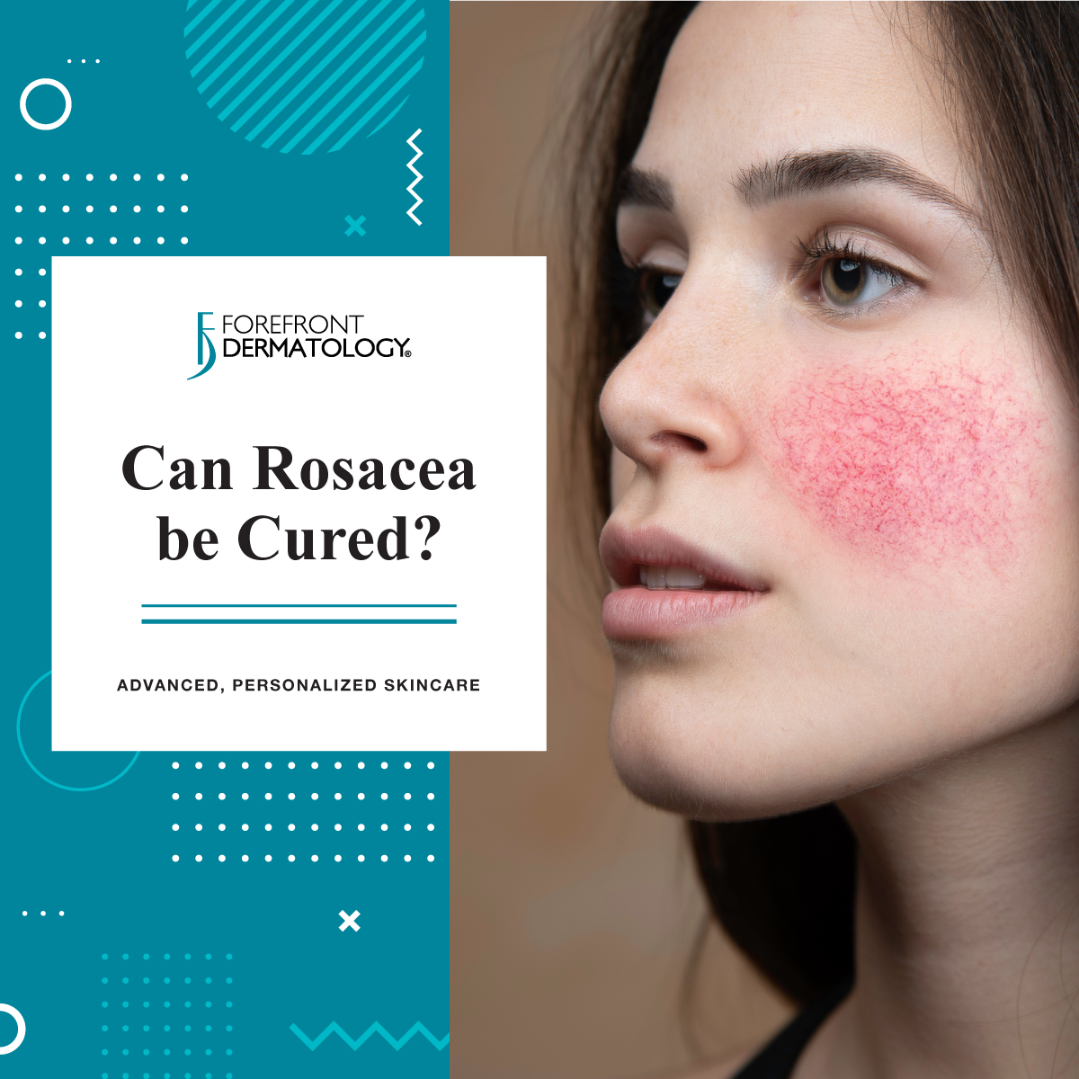 Can Rosacea Be Cured?| Forefront Dermatology