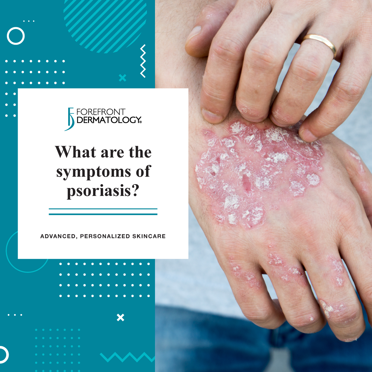 Symptoms of Psoriasis