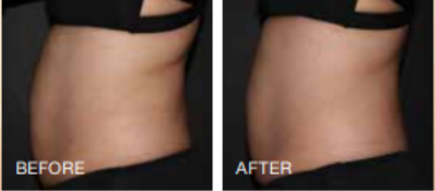 Before and After