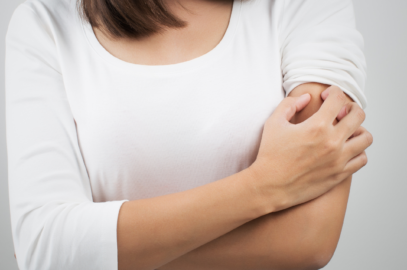 What is Keratosis Pilaris?