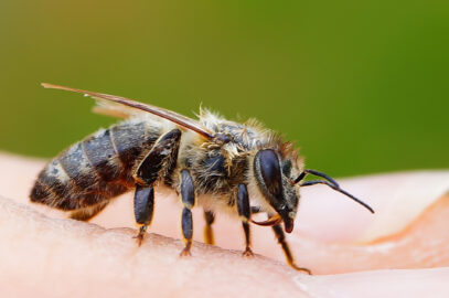 How to Treat a Bee Sting