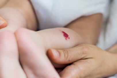 What is a Strawberry Hemangioma?