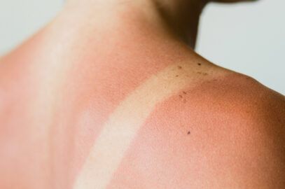 First Aid Treatments for Burns
