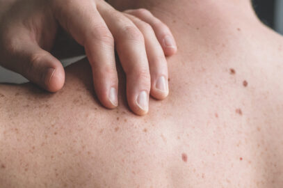 When Should I See A Dermatologist?