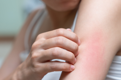 Amoxicillin Rash