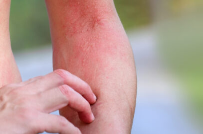 A Guide to Common Summer Rashes